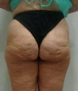 Extracción de biopolímeros del cuerpo - foto antes - caso 1
