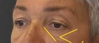 eliminar ojeras con ácido hialurónico