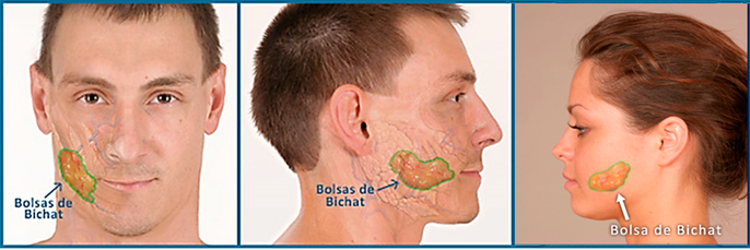 Bolas de Bichat