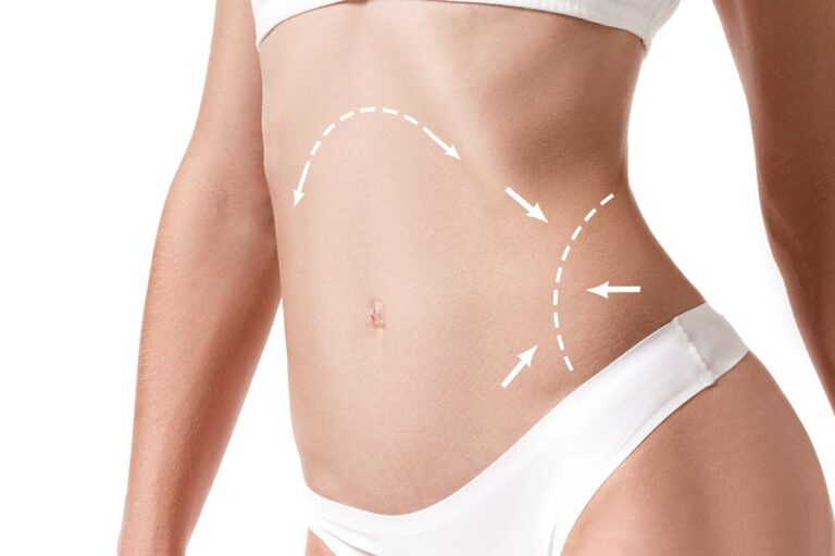 Eliminar grasa del abdomen con lipotene