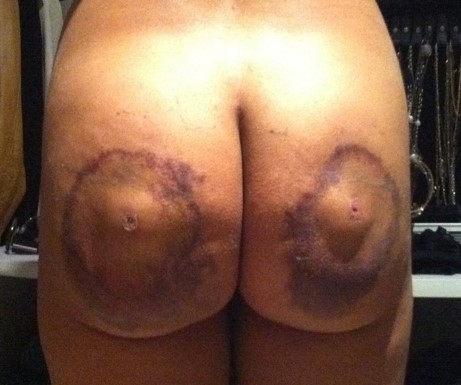 Biopolímeros en los glúteos