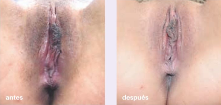 peeling de vagina - foto antes y despues - caso 1