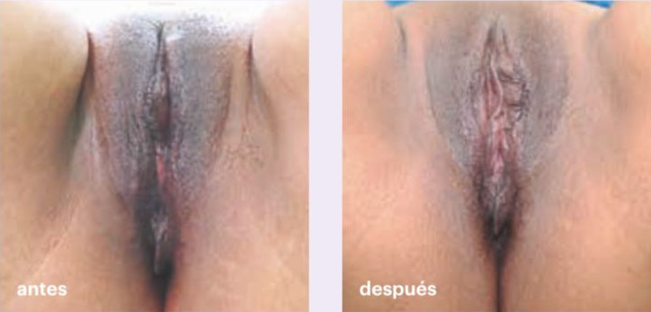 peeling de vagina - foto antes y despues - caso 2
