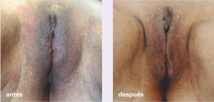 peeling de vagina - foto antes y despues - caso 3